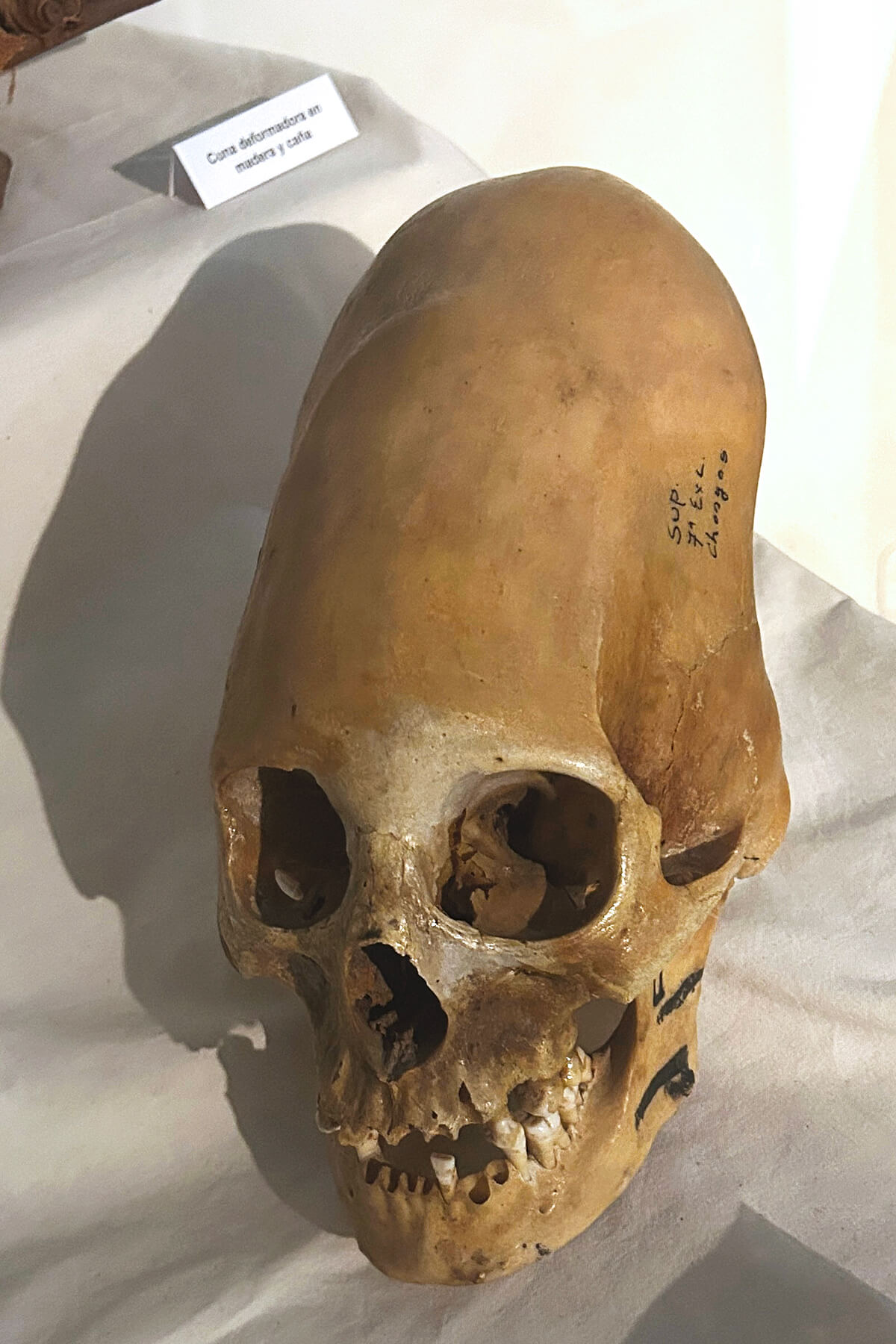 Deformed Skull